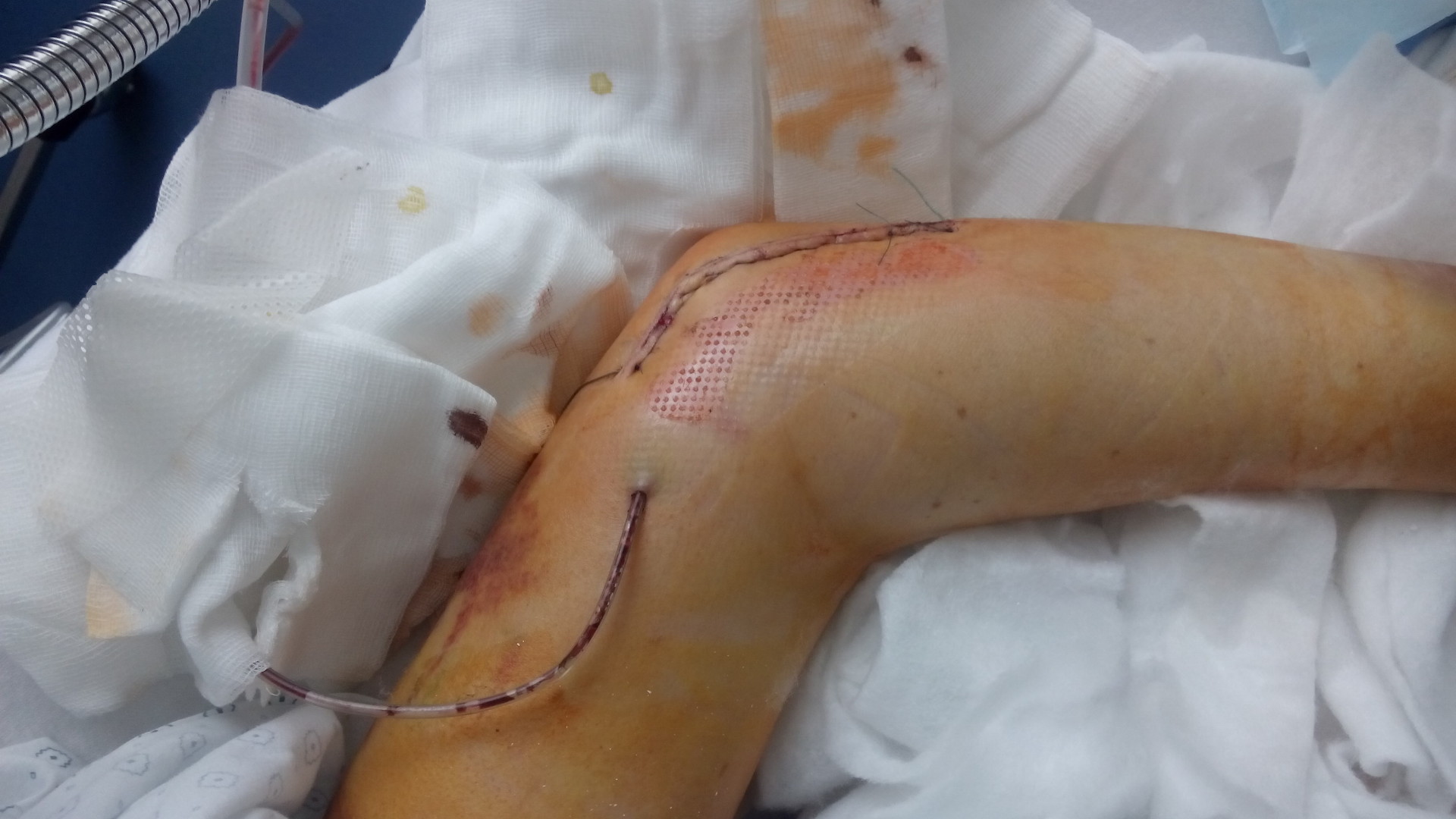 Image of an arm after surgery.