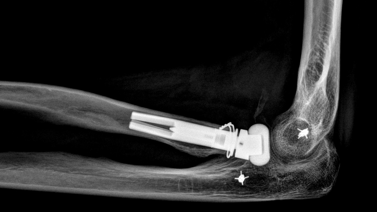 An X-Ray of the arm with the implant.