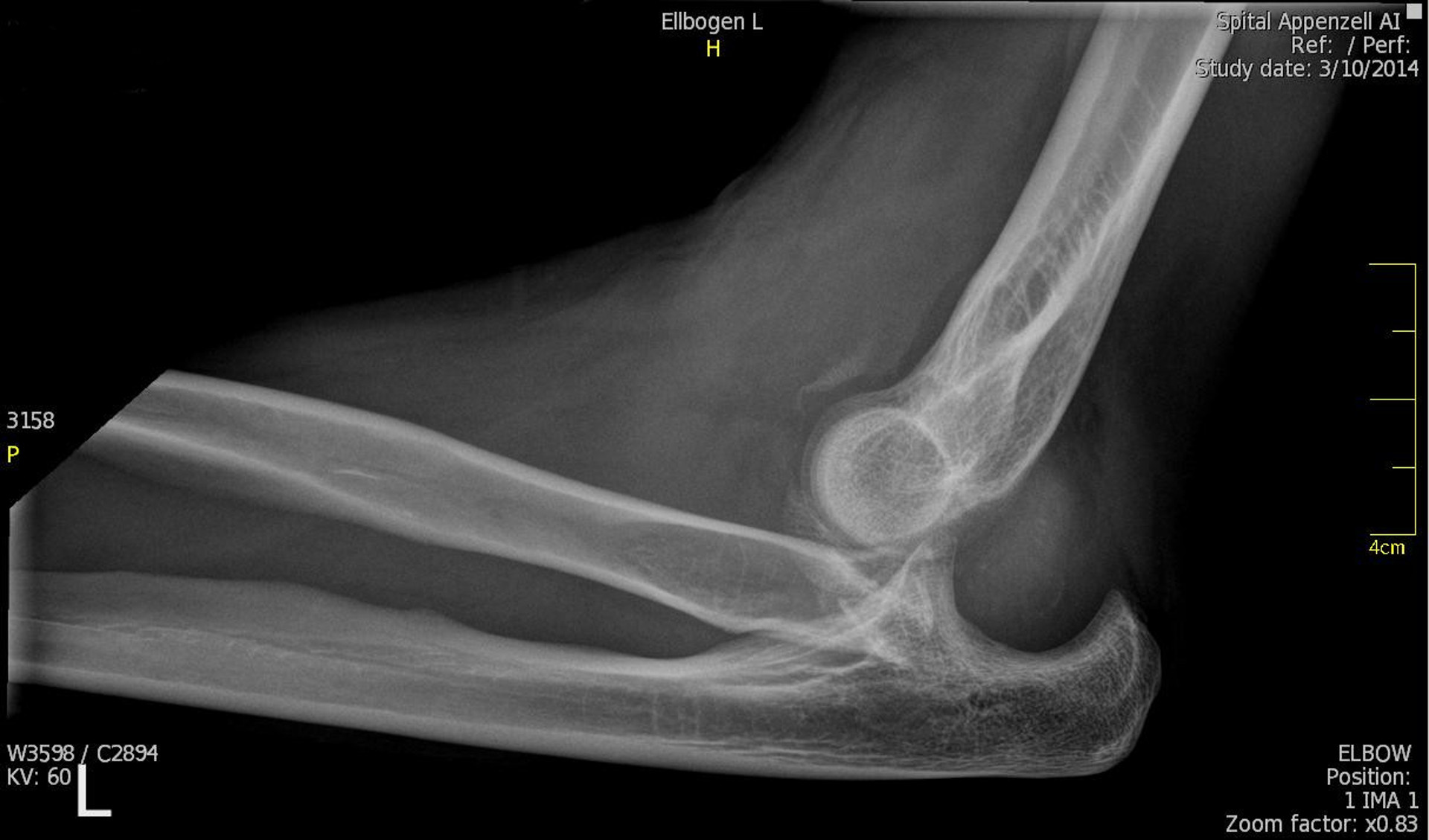 An X-Ray of a dislocated elbow.
